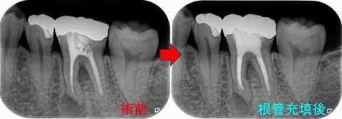 死腔があっても普通に治る根尖病変 - EE DENTAL_Blog